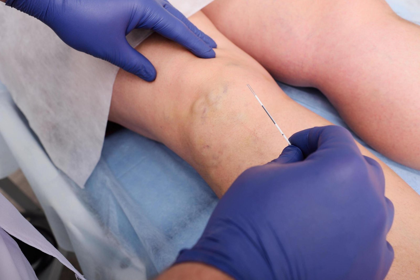 Varicose Veins Image