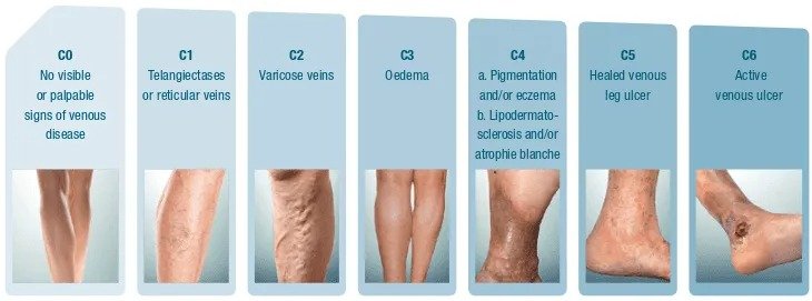 Varicose Veins Image